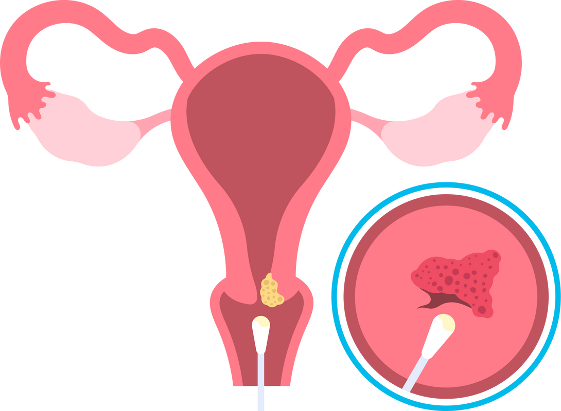 Exam women vagina infection hiv aids hysterectomy vaginal atrophy Female reproductive system uterus